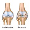 Mengenal Osteoartritis