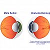 Sudahkah Anda Mengetahui Retinopati Diabetik?